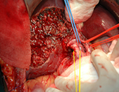 Removal of Cancer Gallbladder
